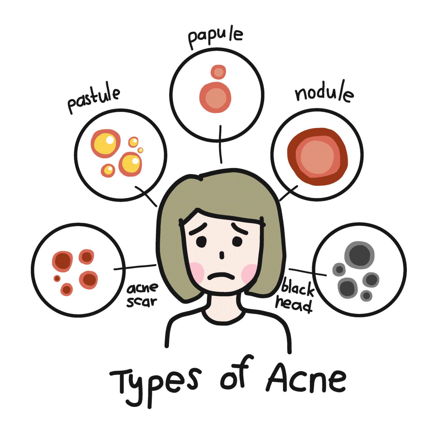 type of Acne
